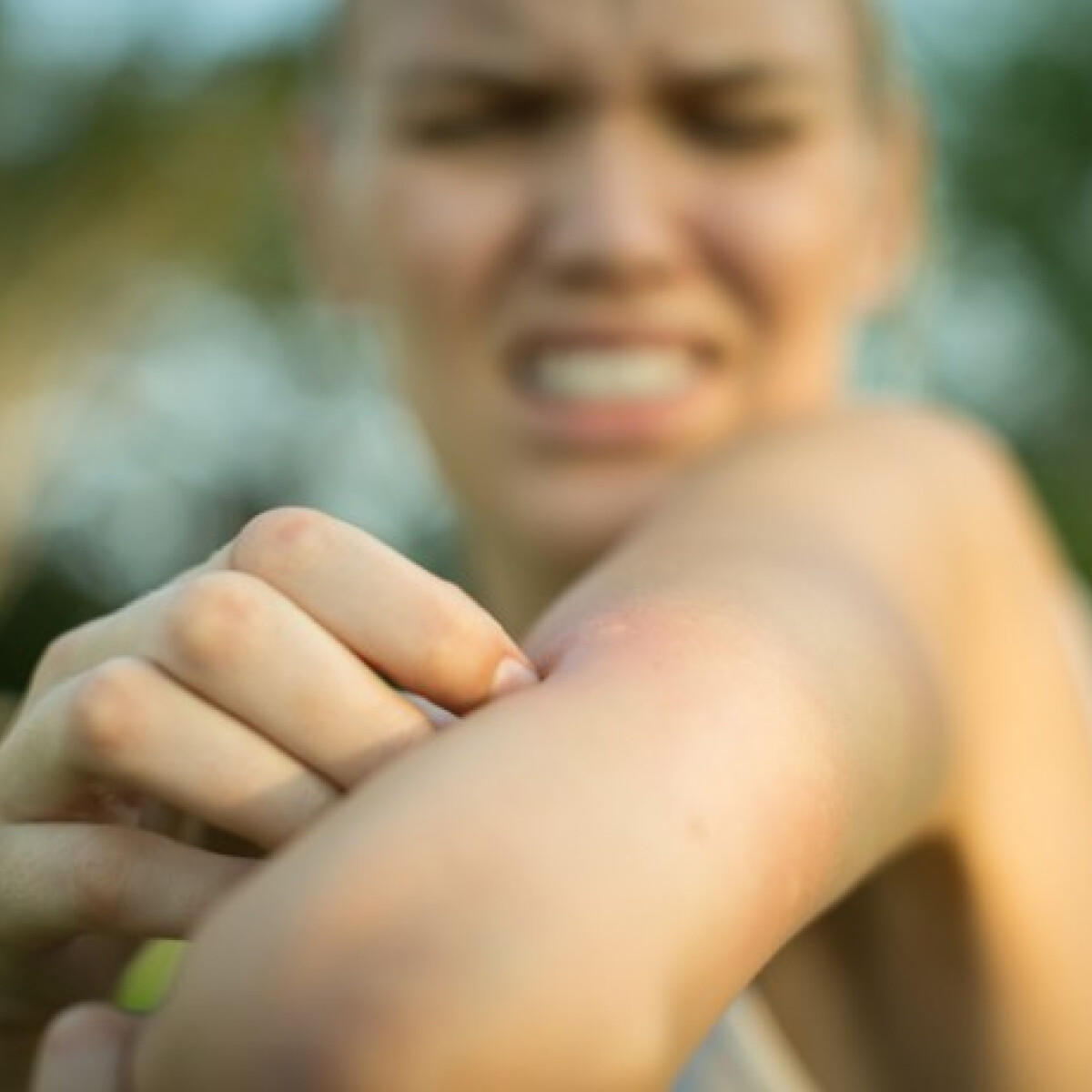 Rengeteg csípés van rajtad? – Ezért esznek téged jobban a szúnyogok, mint mást