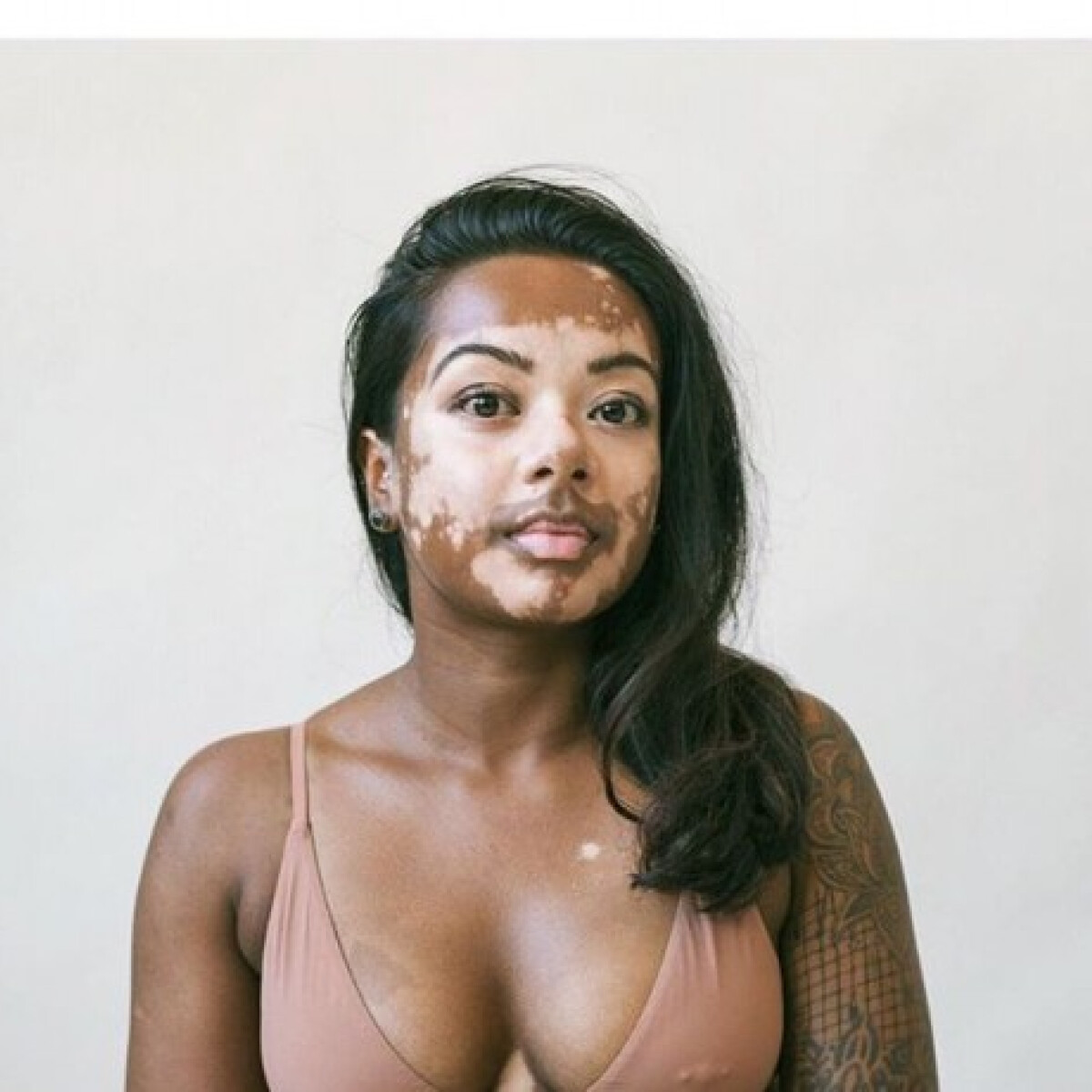 Különleges bőrbetegséggel élő nőkről készült varázslatos fotósorozat